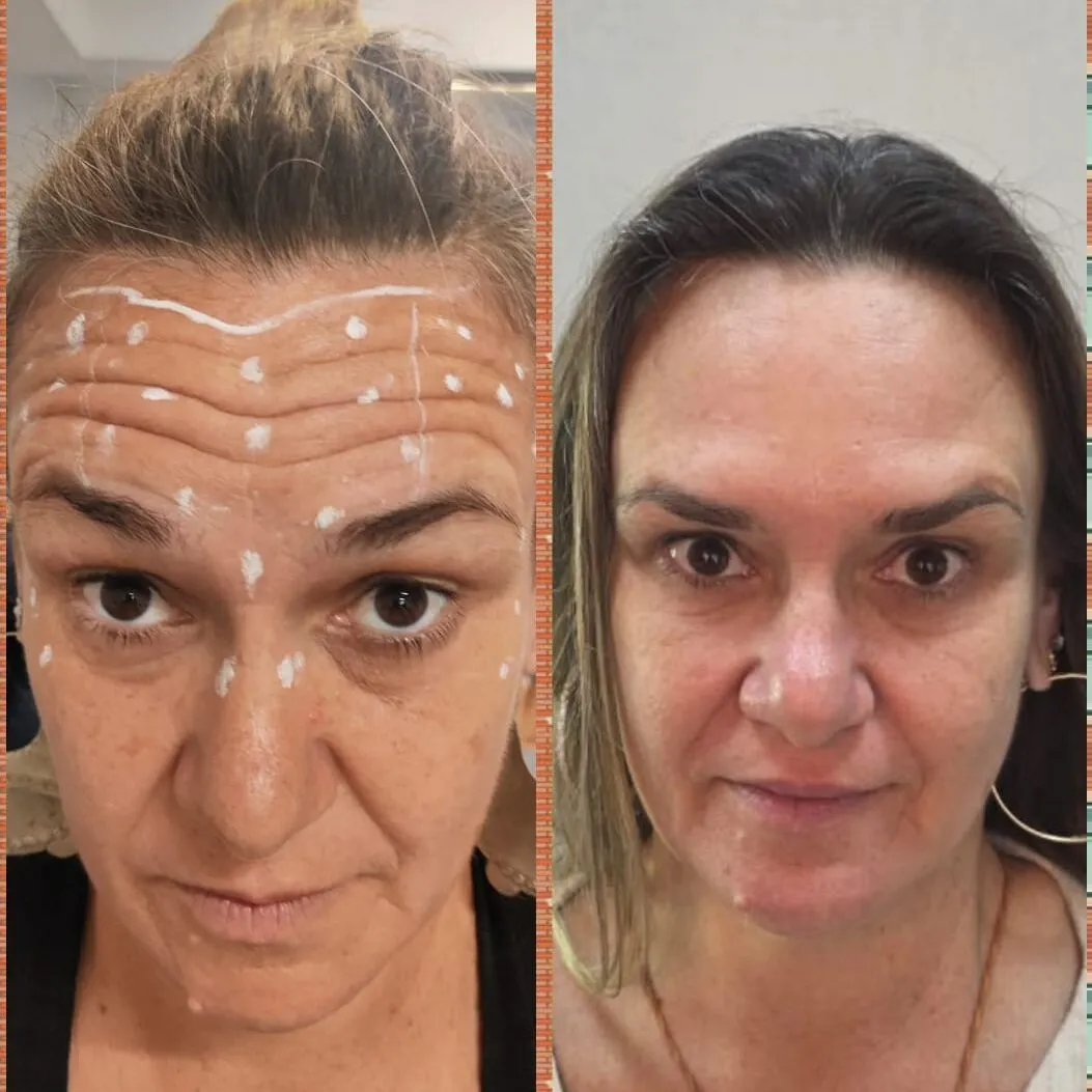 Antes e depois da aplicação de toxina botulínica em paciente modelo do curso