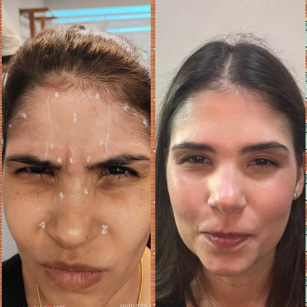 Antes e depois da aplicação de toxina botulínica em paciente modelo do curso