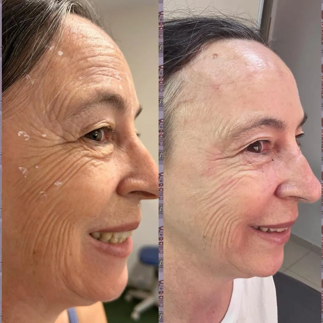 Antes e depois da aplicação de toxina botulínica em paciente modelo do curso