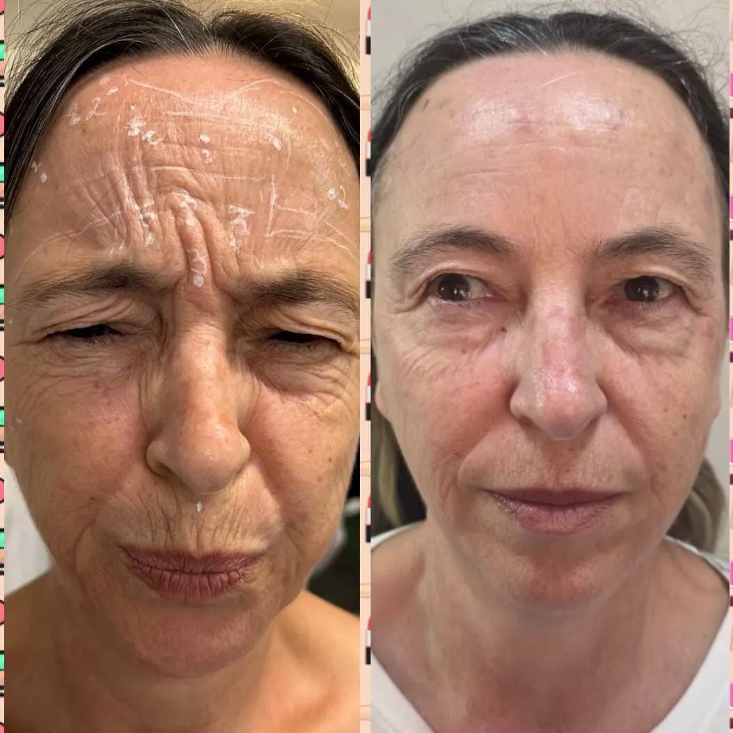 Antes e depois da aplicação de toxina botulínica em paciente modelo do curso